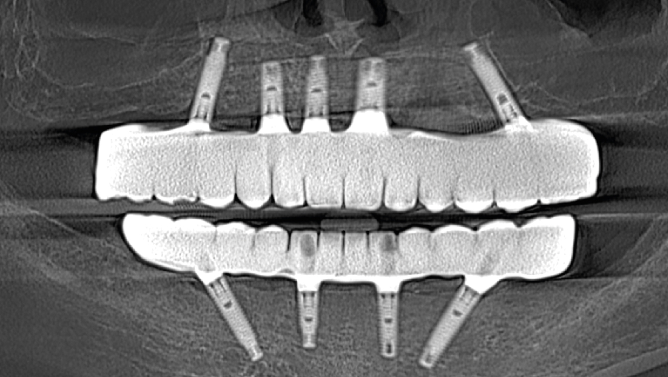 matrix® fullarch solution for your dental clinic